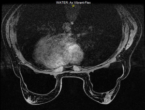 Risonanza Magnetica della Mammella